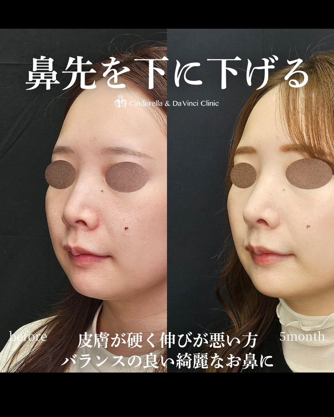 鼻先を下げる鼻整形の画像