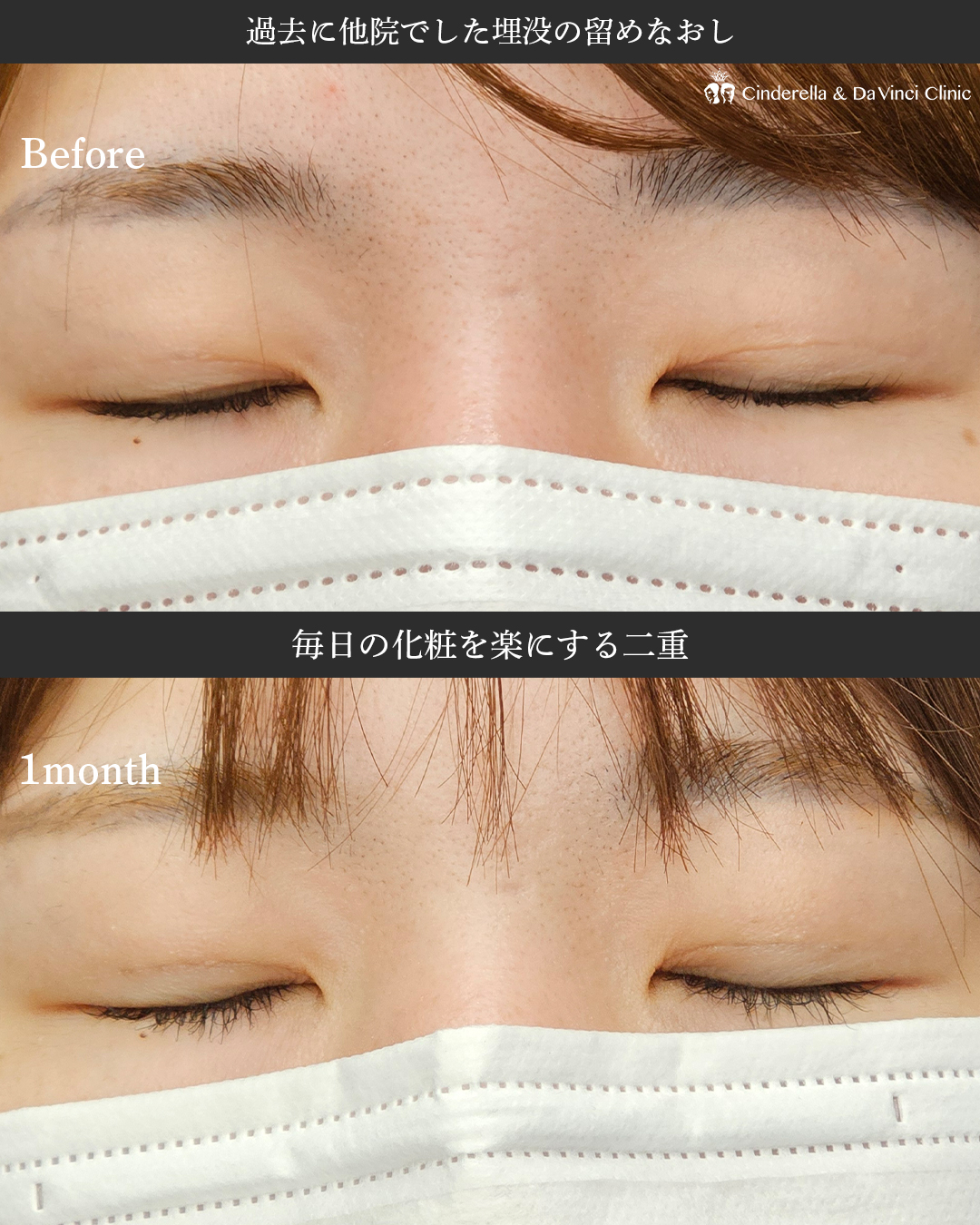 佐藤医師が作る自然な二重の画像