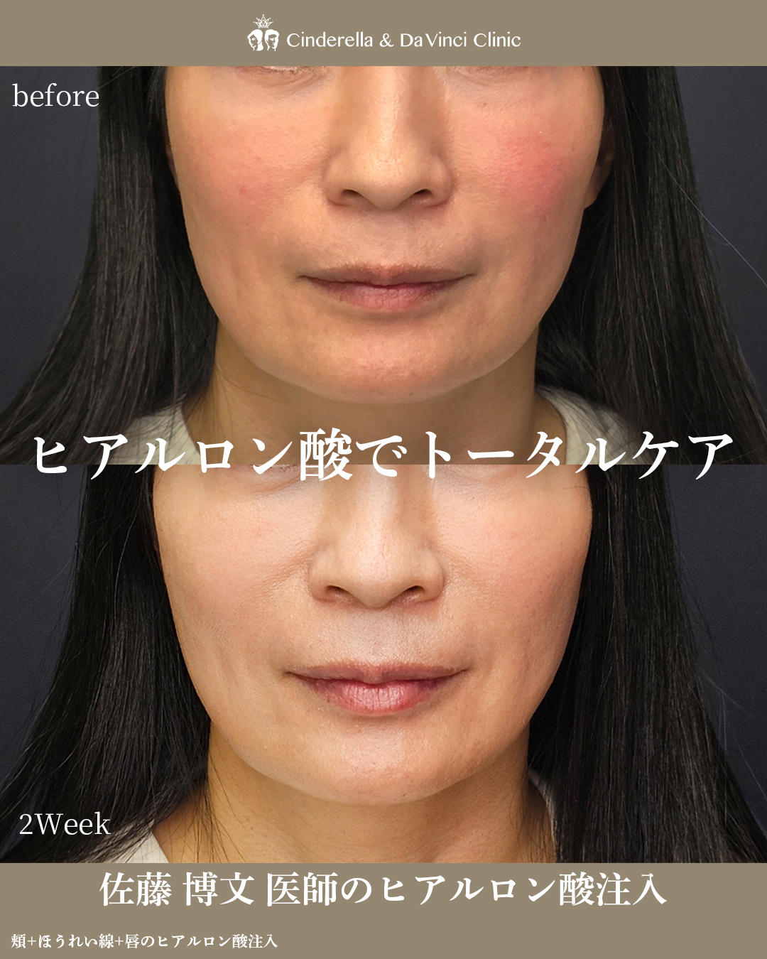 ヒアルロン酸でトータルケアの画像