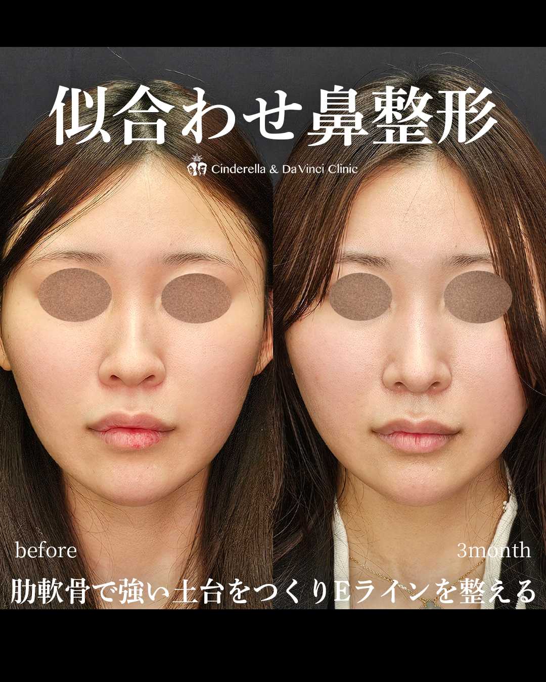 似合わせ鼻整形の画像