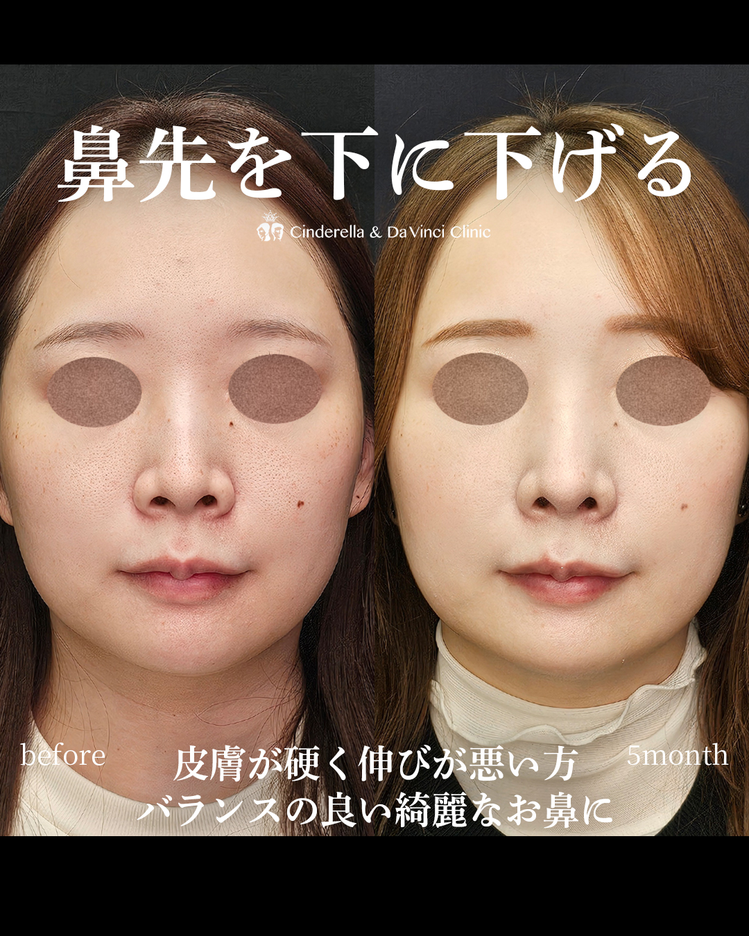 鼻先を下げる鼻整形の画像