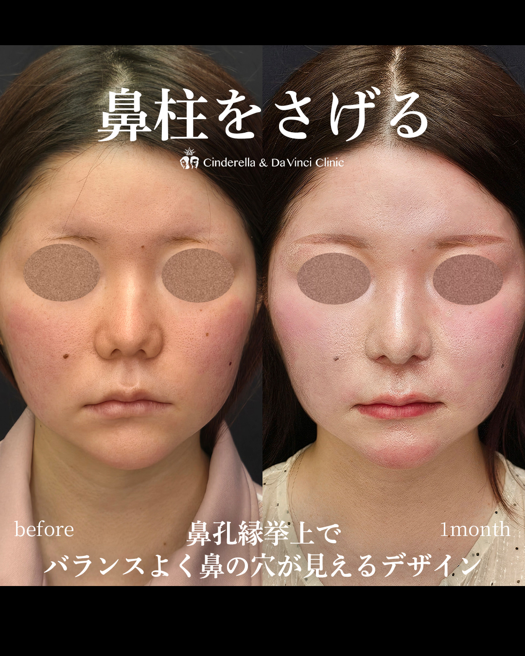 バランスよく自然な鼻の画像
