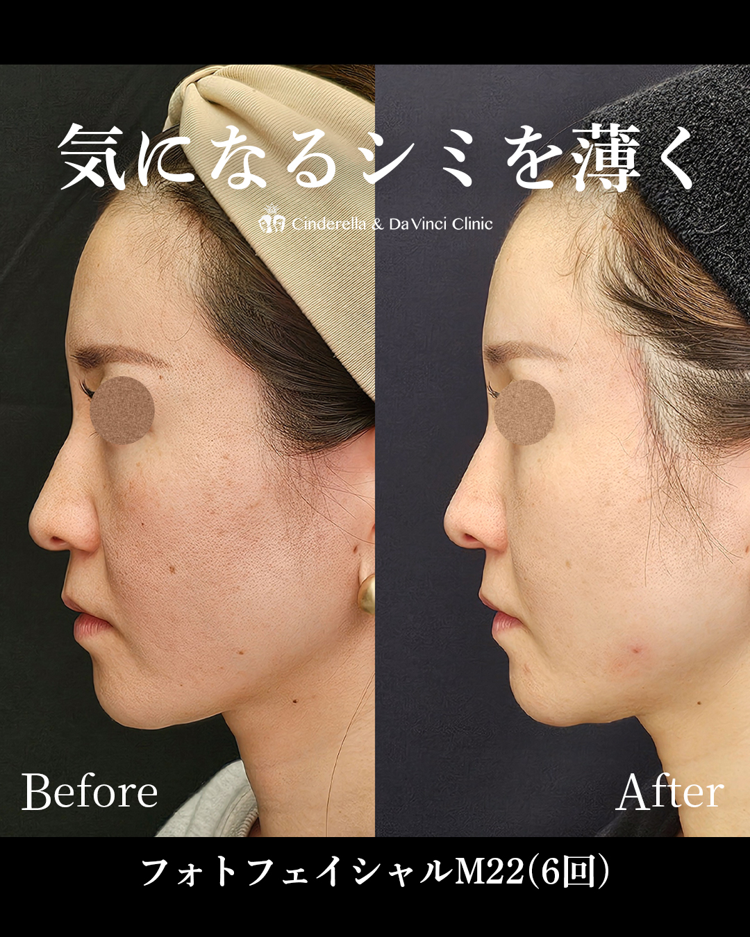 シミ悩みを解消する美肌施術の画像