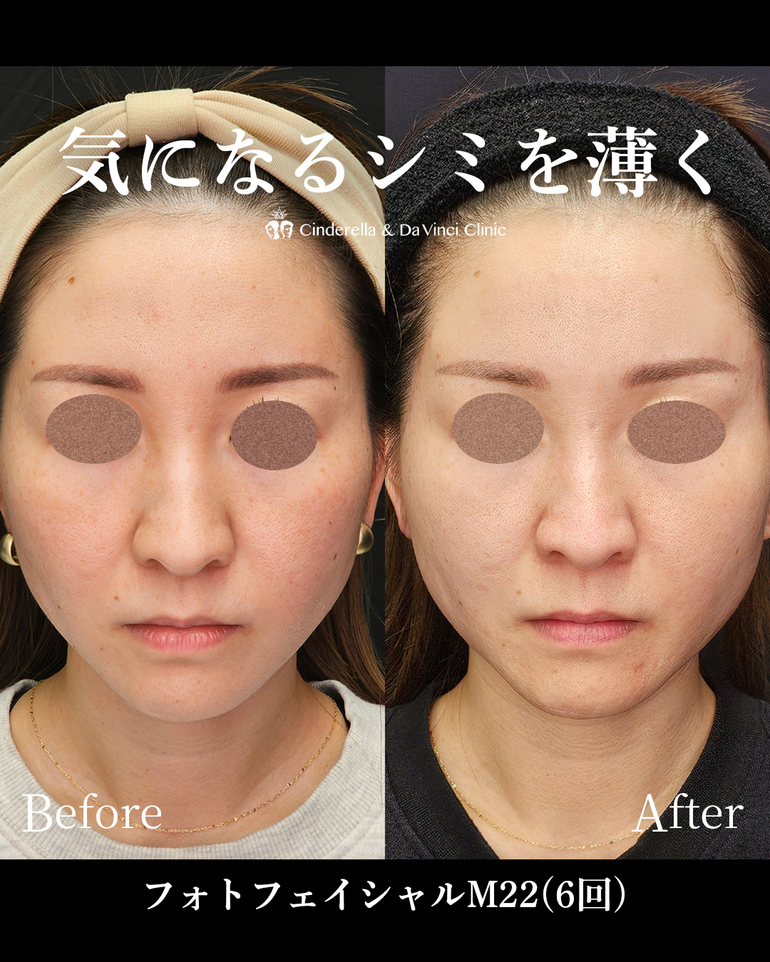 シミ悩みを解消する美肌施術の画像