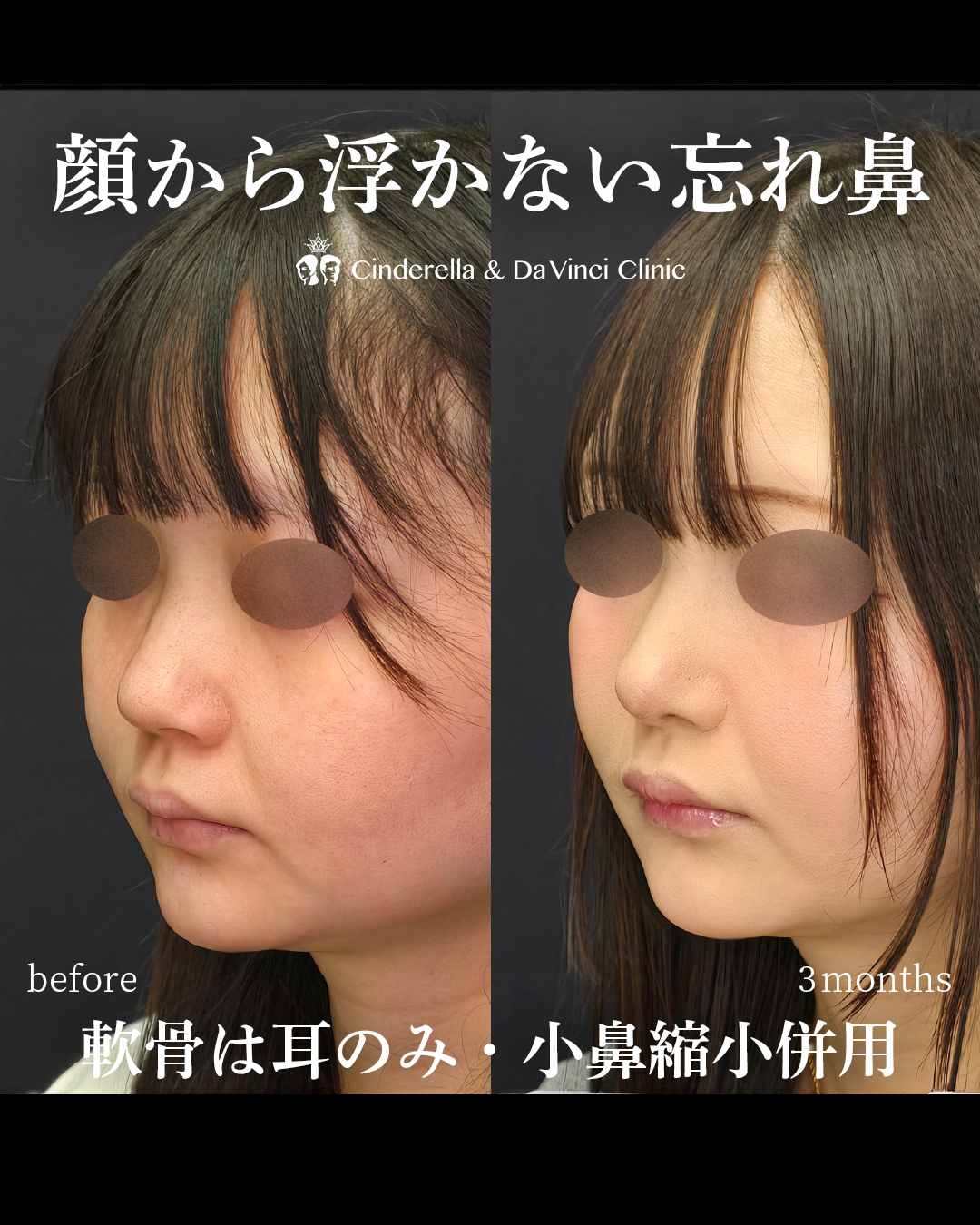 鼻先と小鼻の同時手術で忘れ鼻の画像