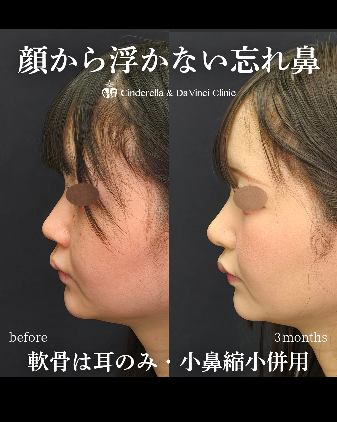 鼻先と小鼻の同時手術で忘れ鼻の画像