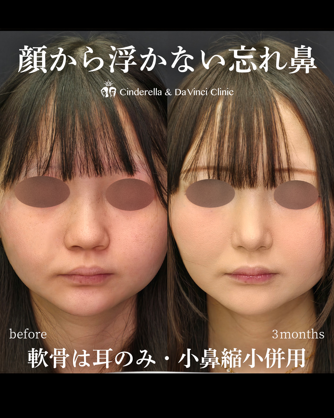 鼻先と小鼻の同時手術で忘れ鼻の画像