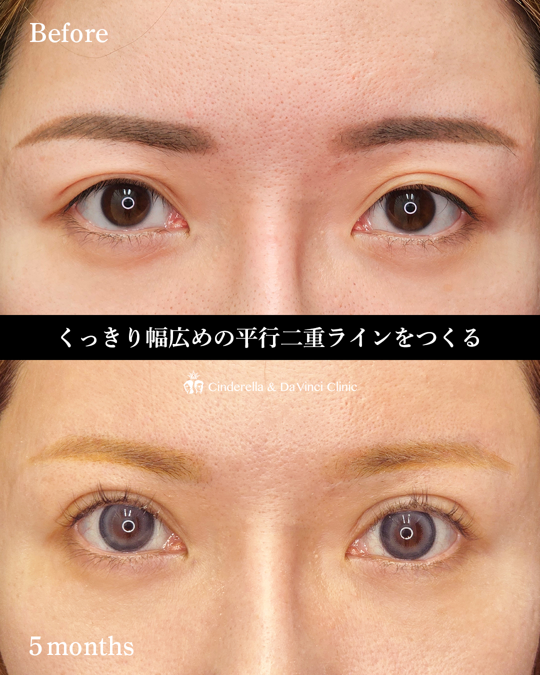 全切開で左右対称の平行二重の画像