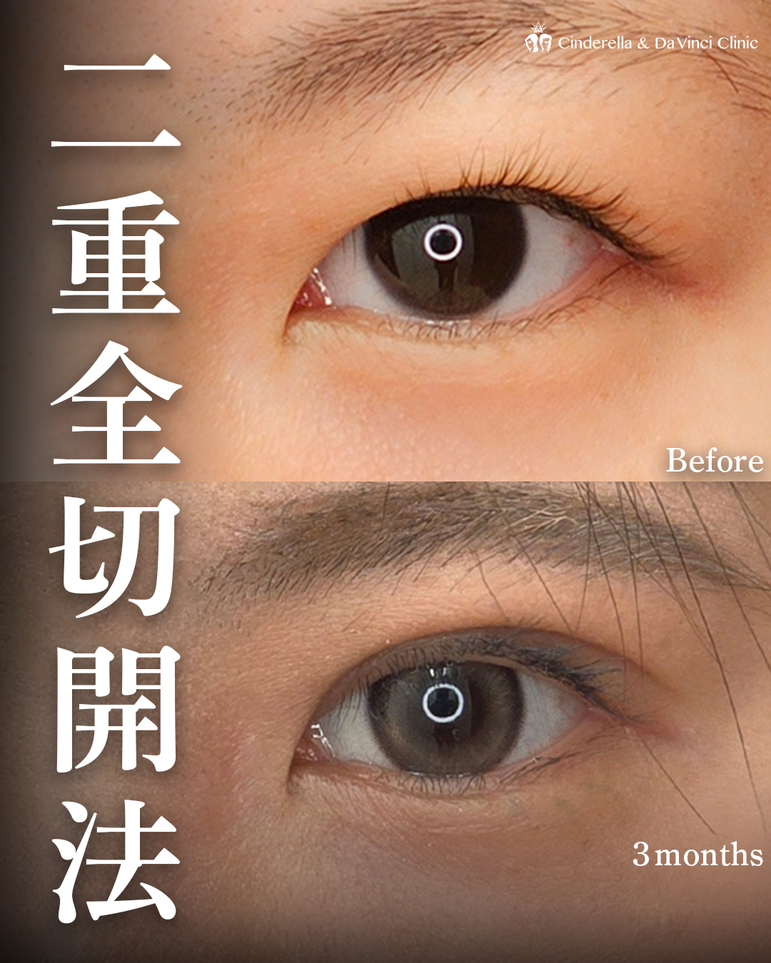 まぶたが厚い人は二重全切開の画像