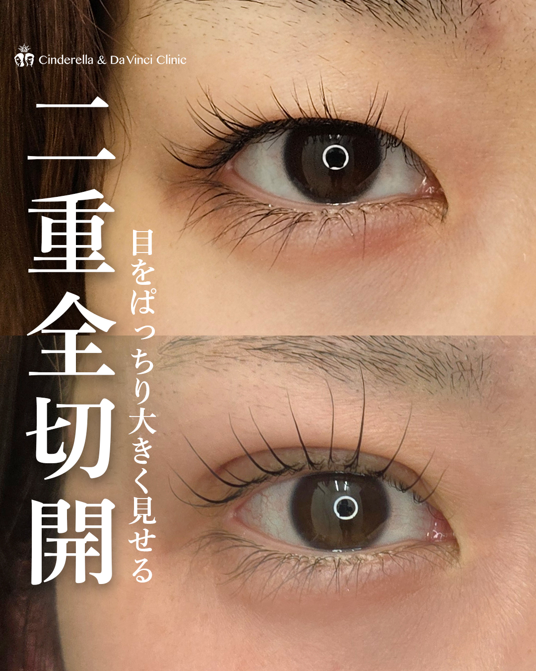 ダウンタイム中もきれいな二重切開の画像