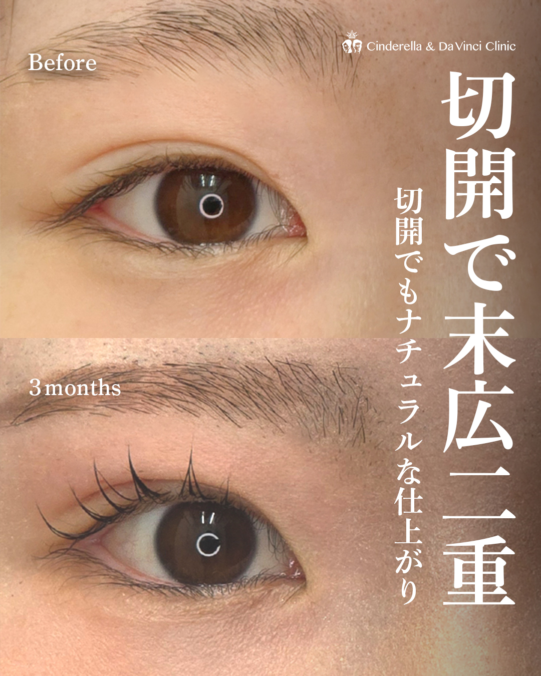 全切開でつくる末広二重の画像