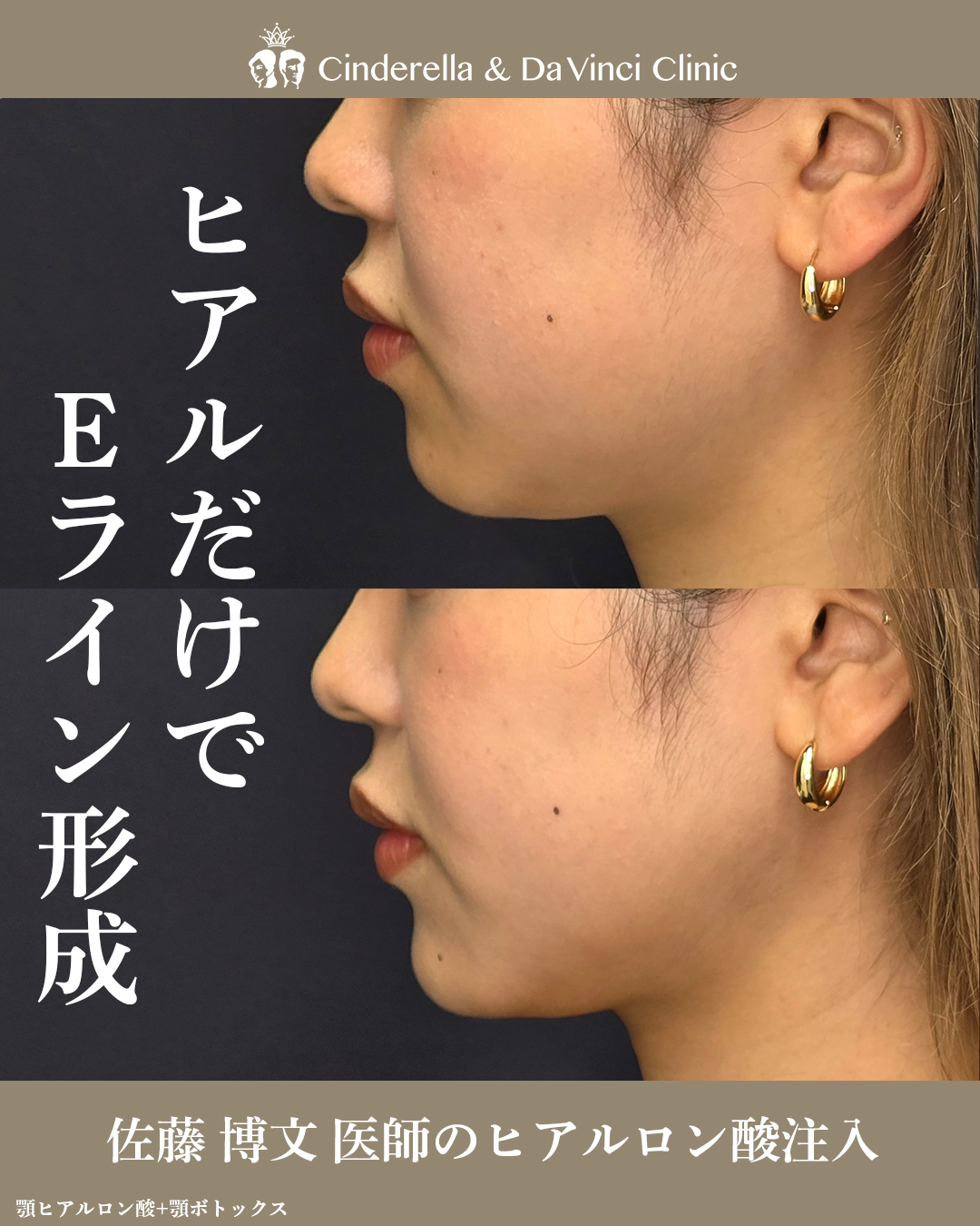 ヒアルだけでEライン形成の画像