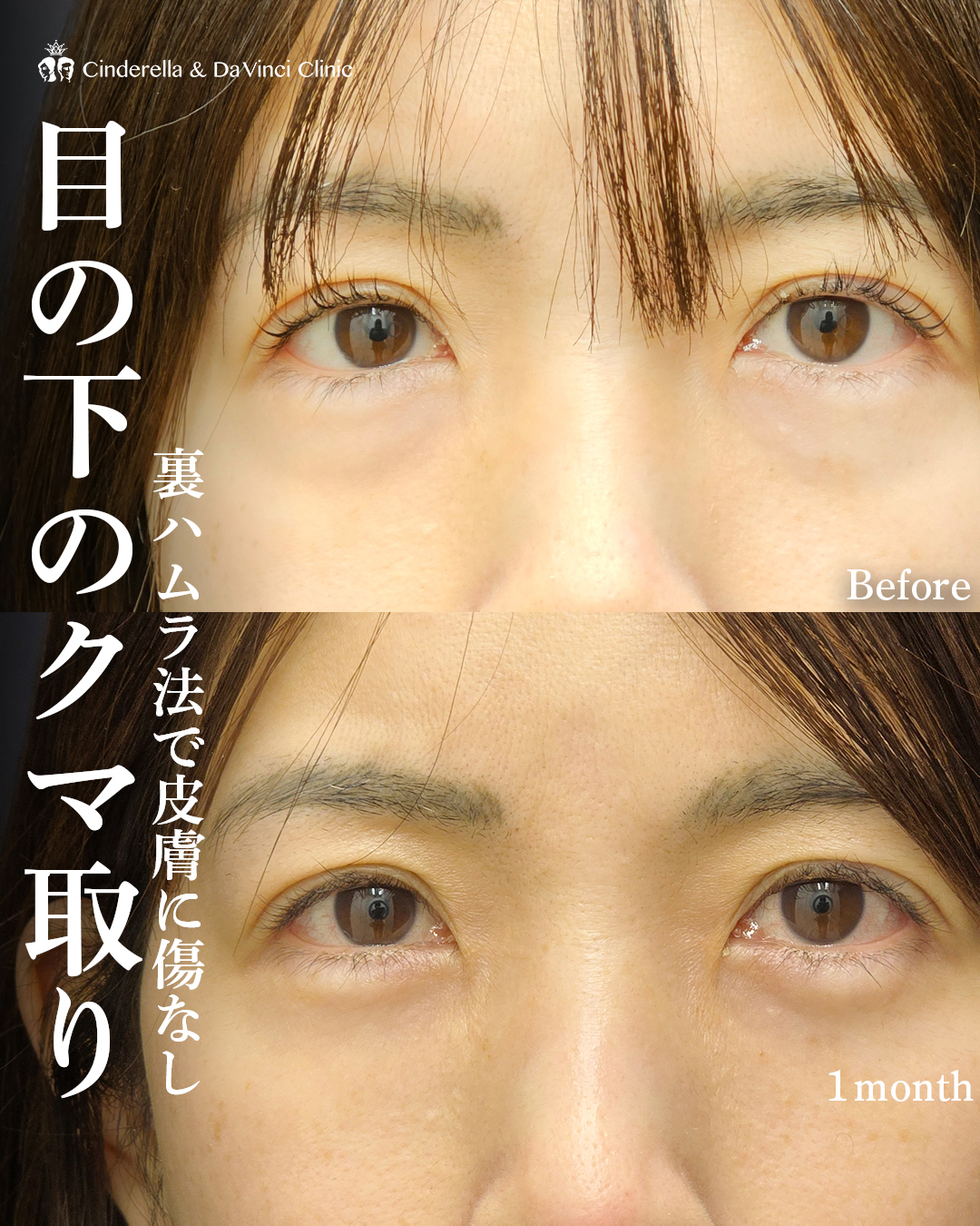 皮膚に傷がつかないクマ取りの画像