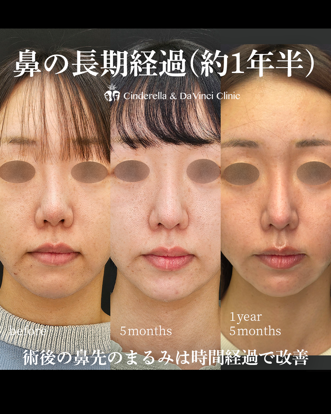鼻整形後1年以上で鼻先の丸み改善の画像