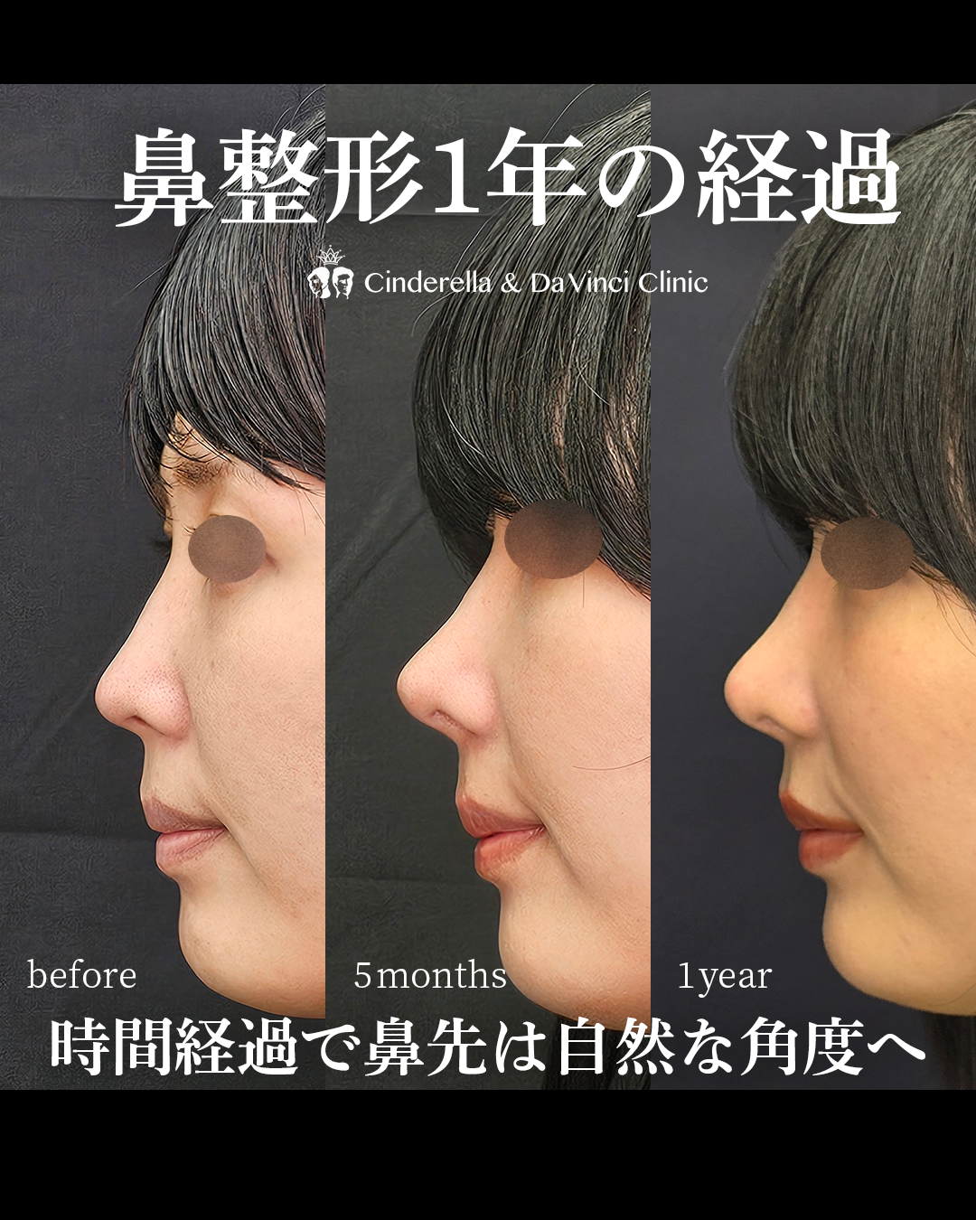 手術後1年経過した鼻先の画像