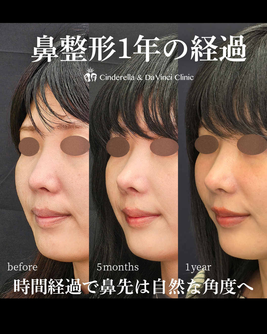 手術後1年経過した鼻先の画像