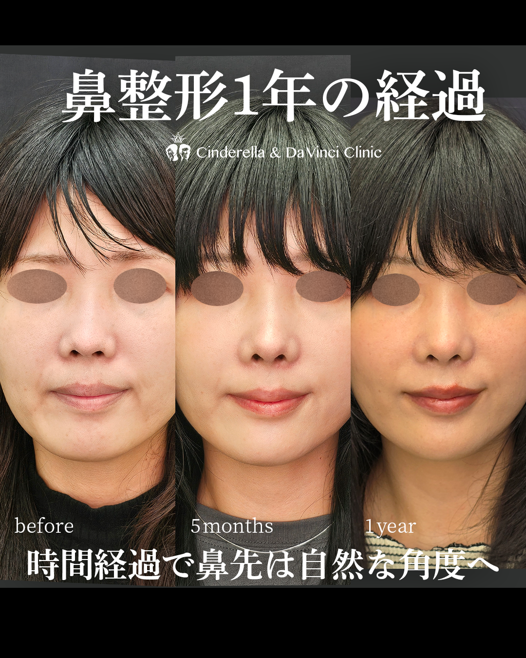 手術後1年経過した鼻先の画像