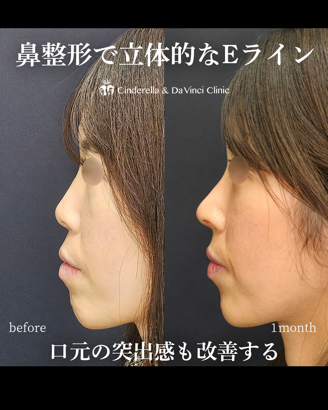 鼻整形で立体的な横顔の画像
