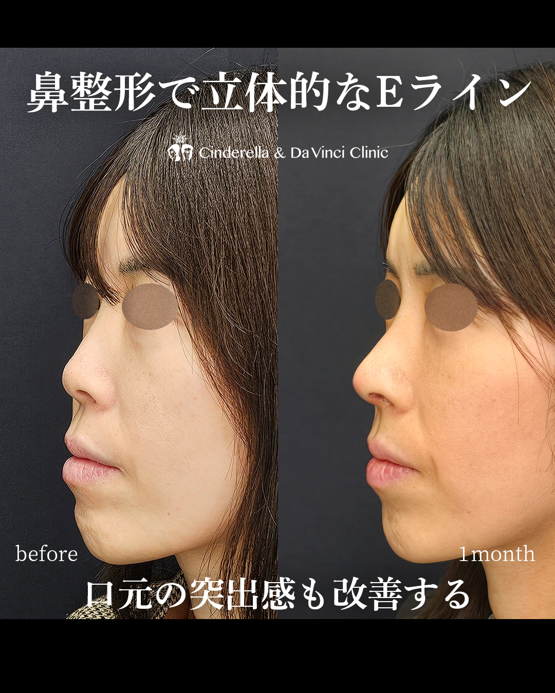鼻整形で立体的な横顔の画像