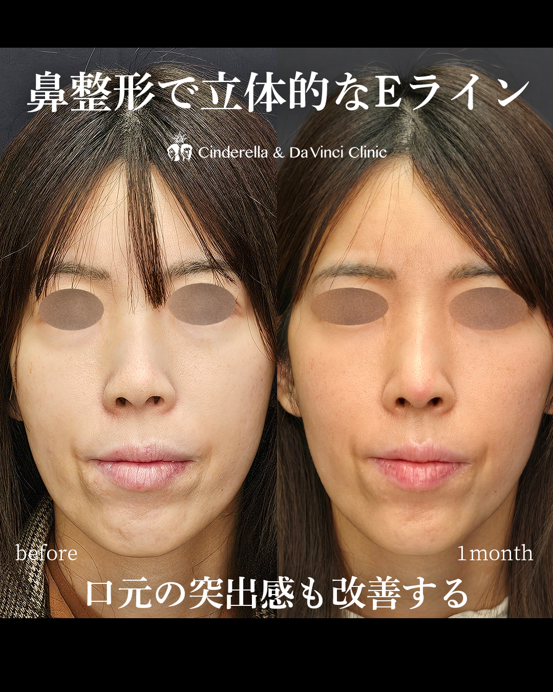 鼻整形で立体的な横顔の画像
