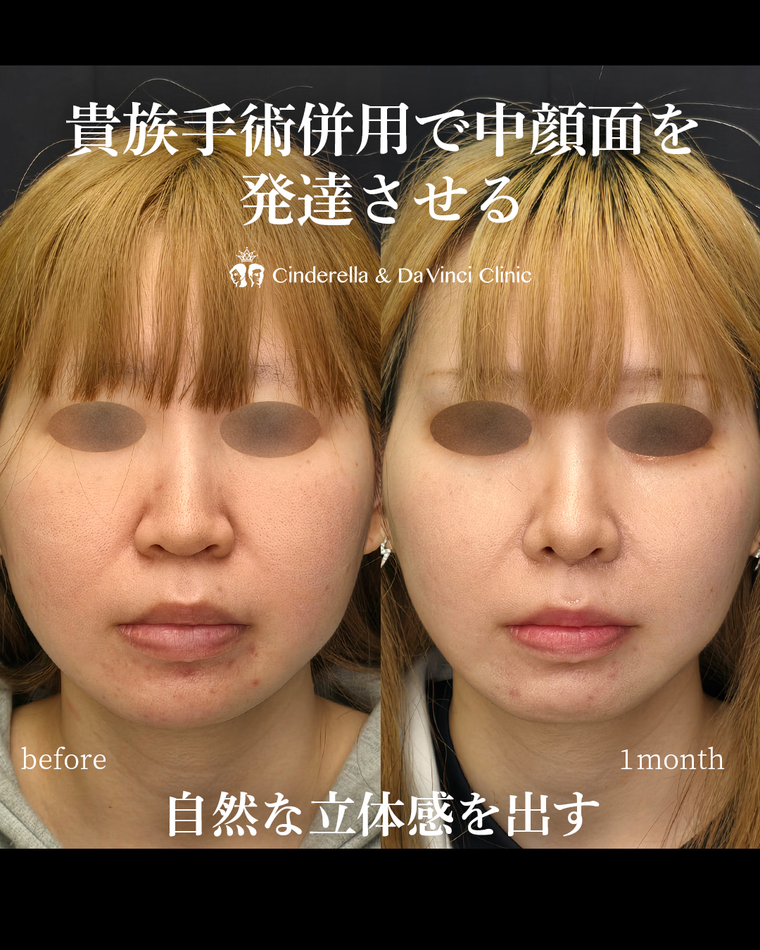 肋軟骨を使用した貴族手術併用の画像