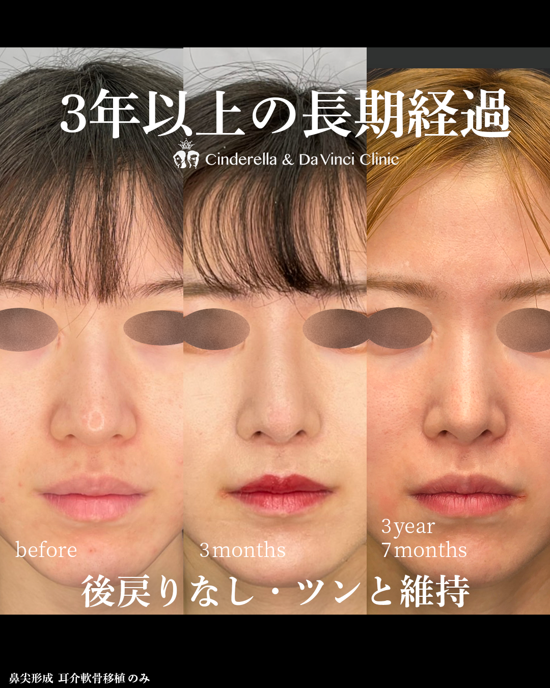 鼻整形から3年後の画像