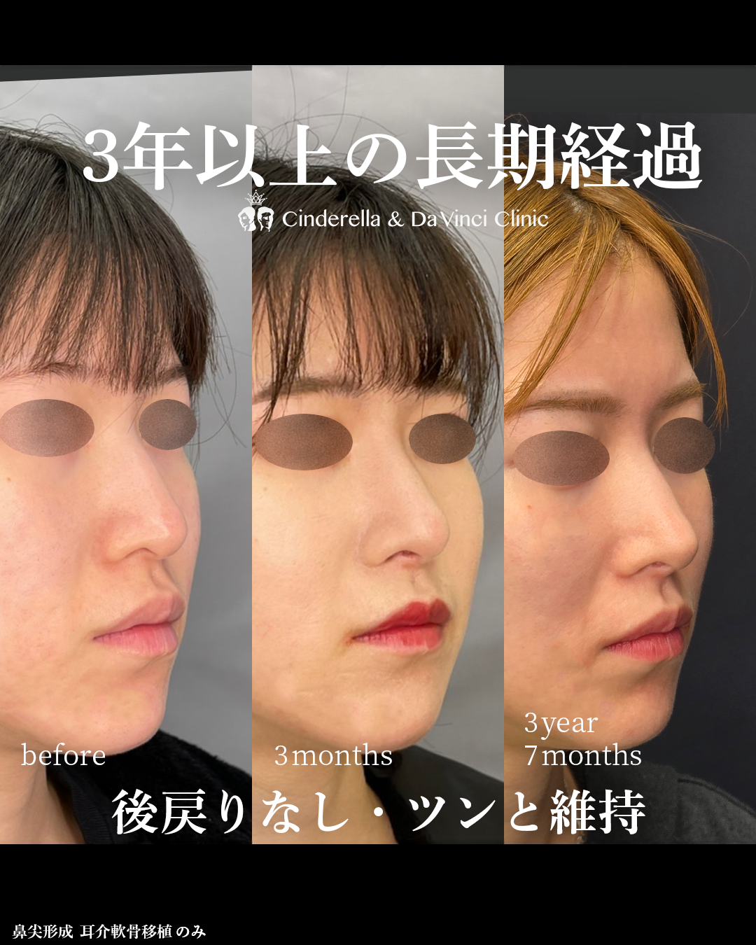 鼻整形から3年後の画像