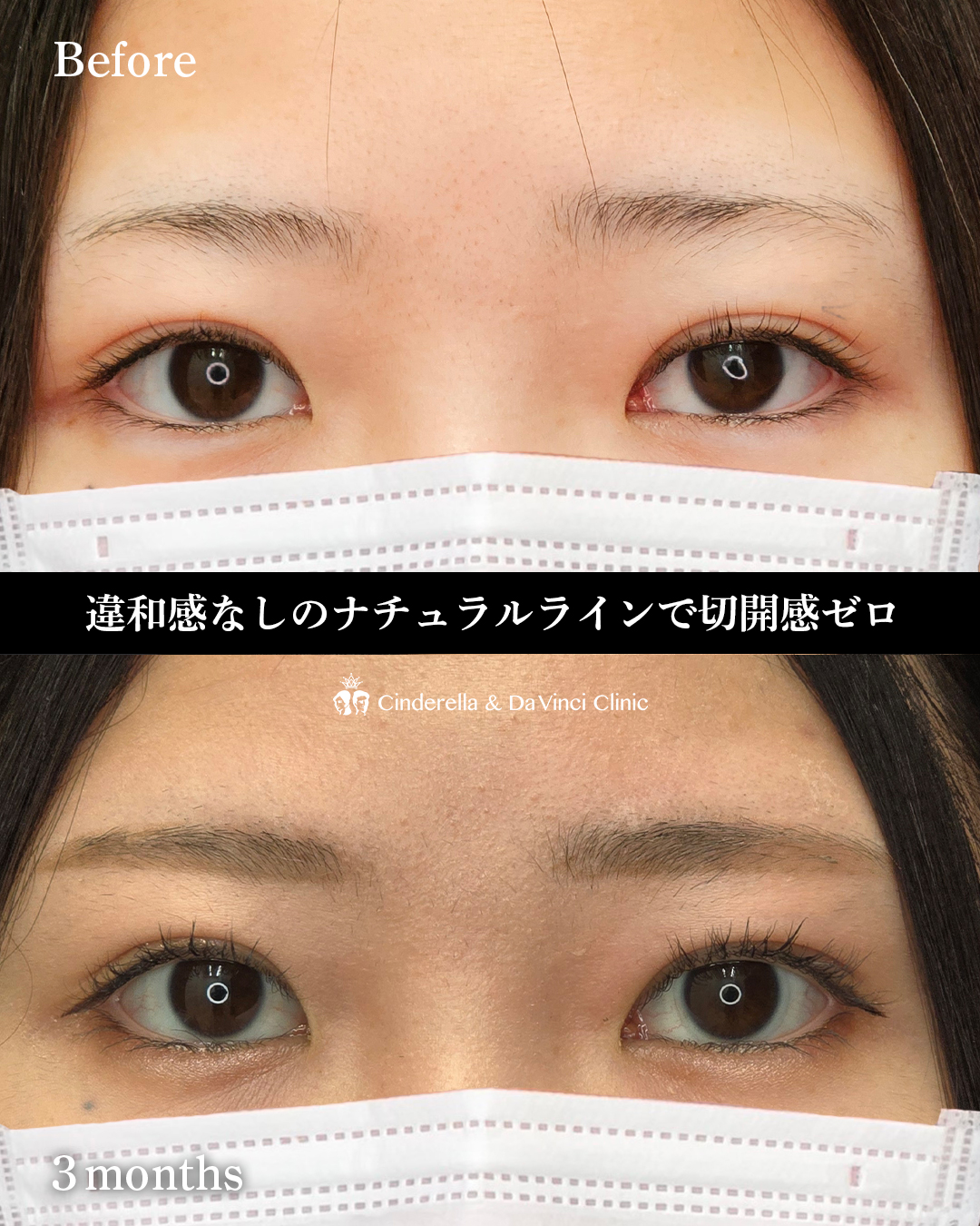 埋没の幅で全切開の画像