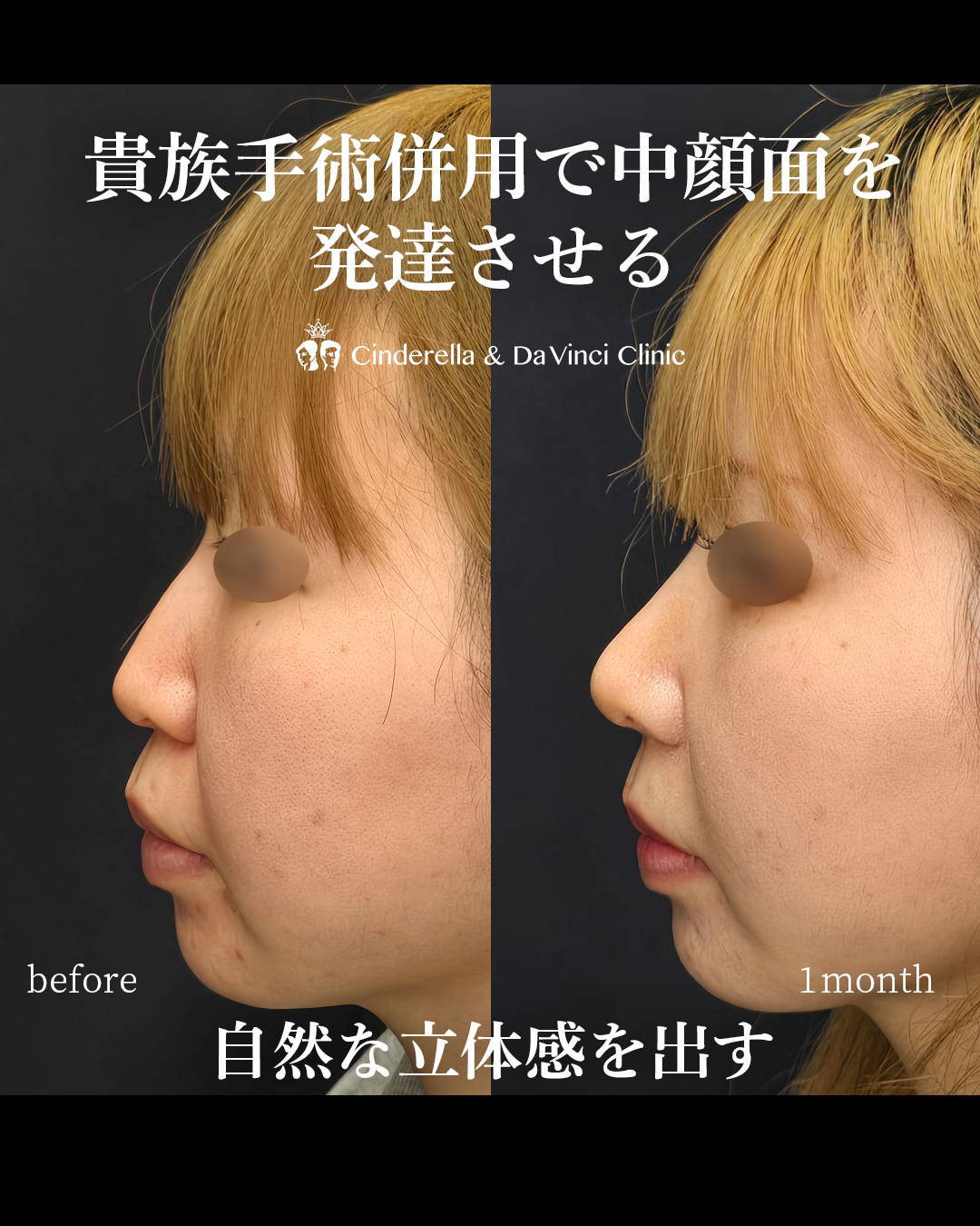 肋軟骨を使用した貴族手術併用の画像