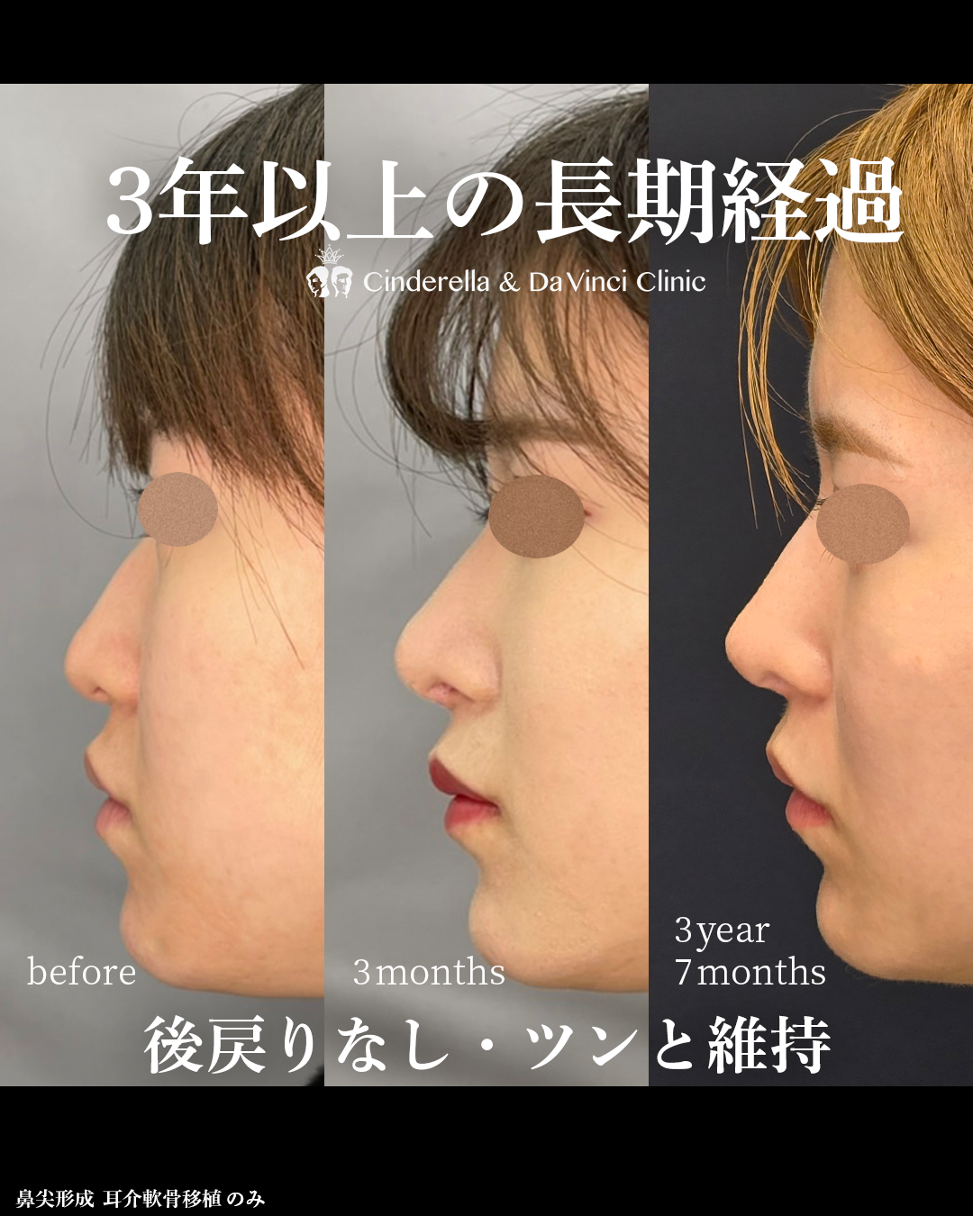 鼻整形から3年後の画像