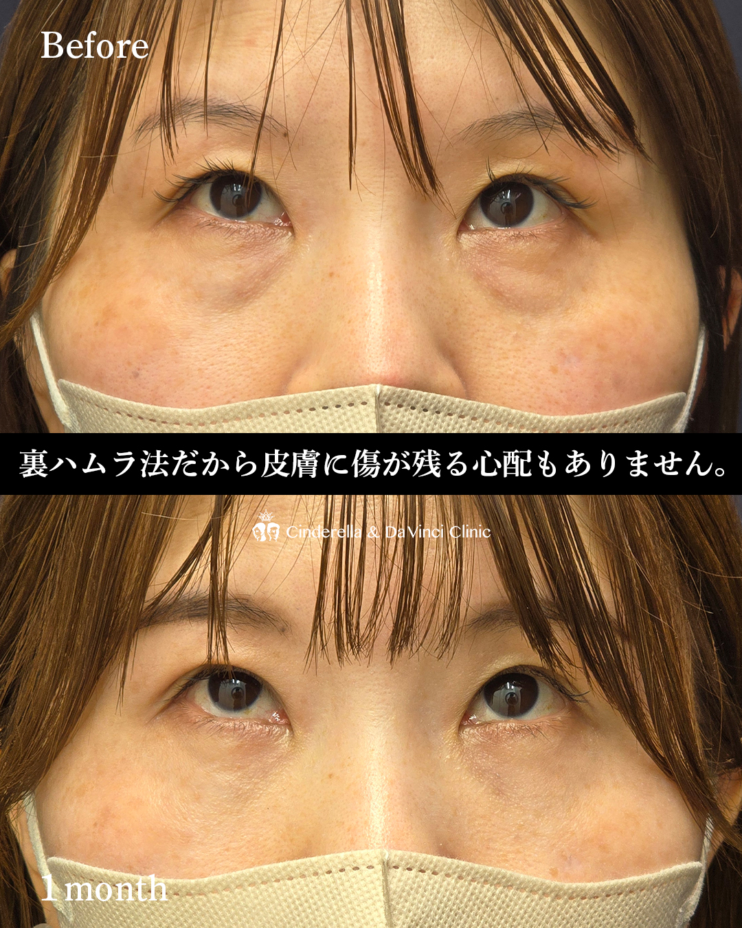 クマ取りで-10歳の画像
