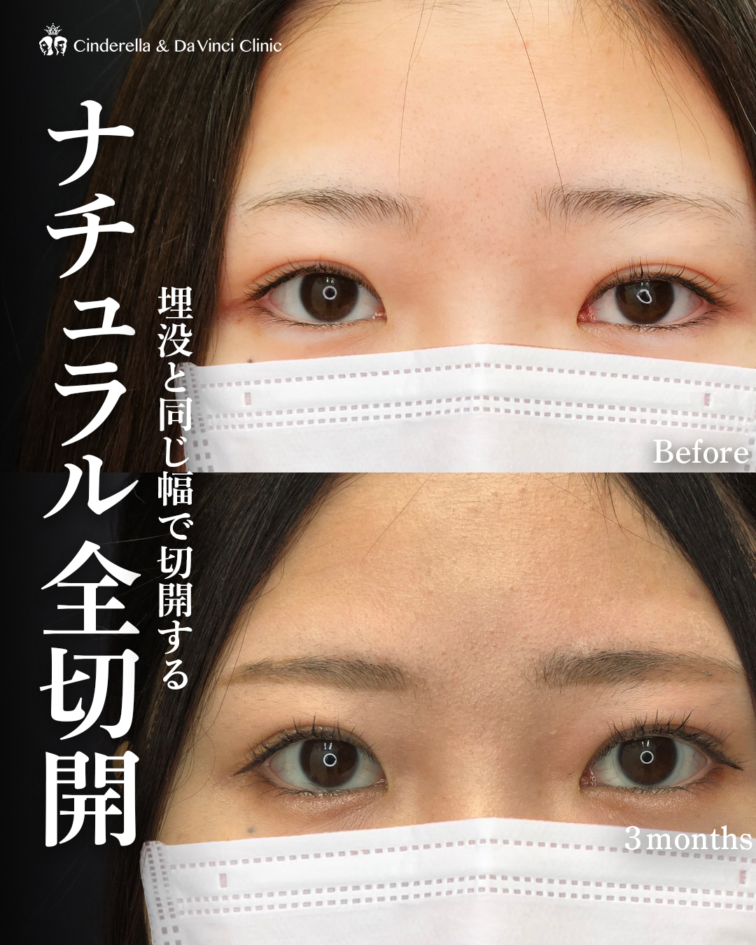 埋没の幅で全切開の画像