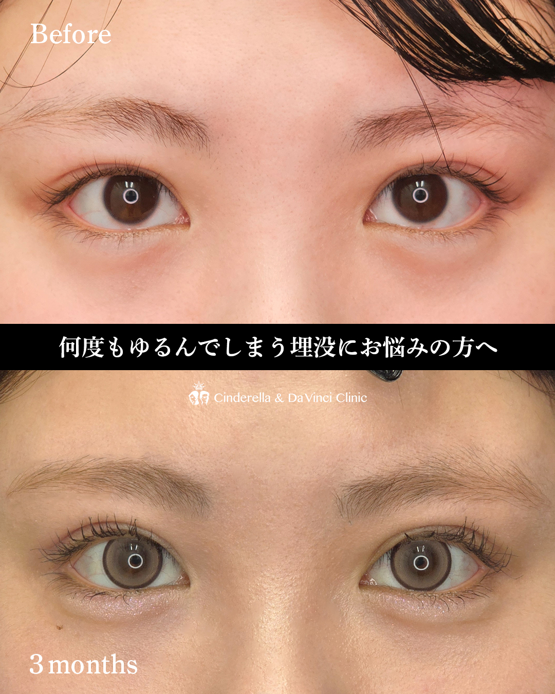 ダウンタイムを感じさせない全切開の画像