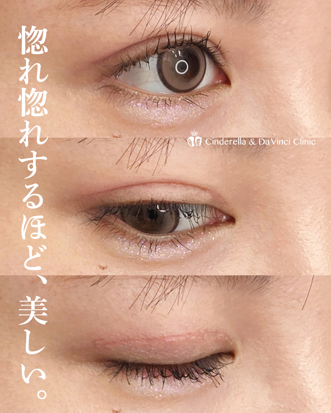 ダウンタイムを感じさせない全切開の画像