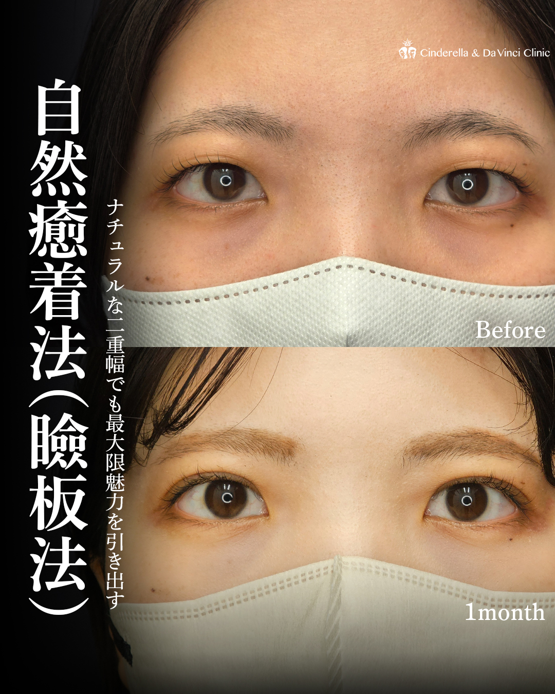 二重埋没でナチュラル盛れ目にの画像