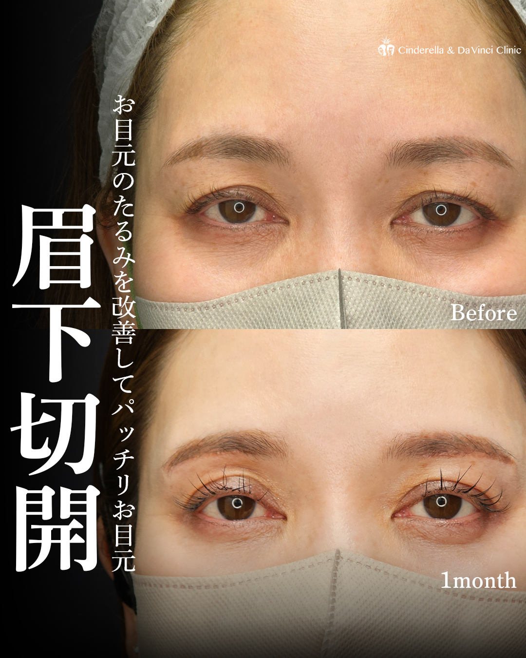 眉下切開でパッチリお目元にの画像