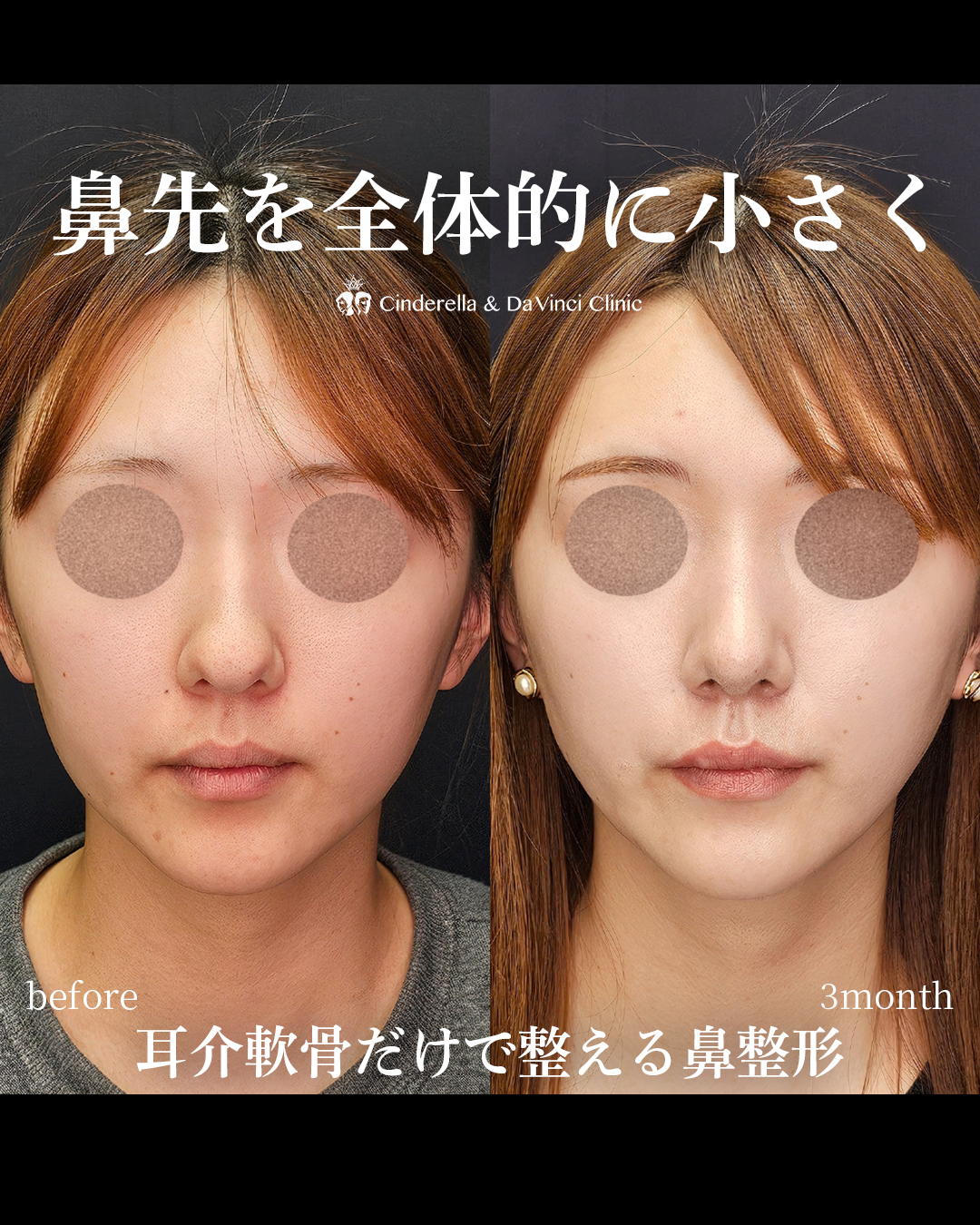 鼻先を全体的に小さくの画像