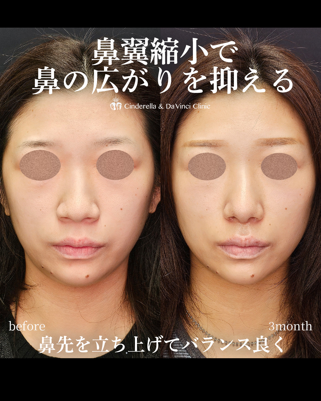 鼻の広がりを抑えるの画像