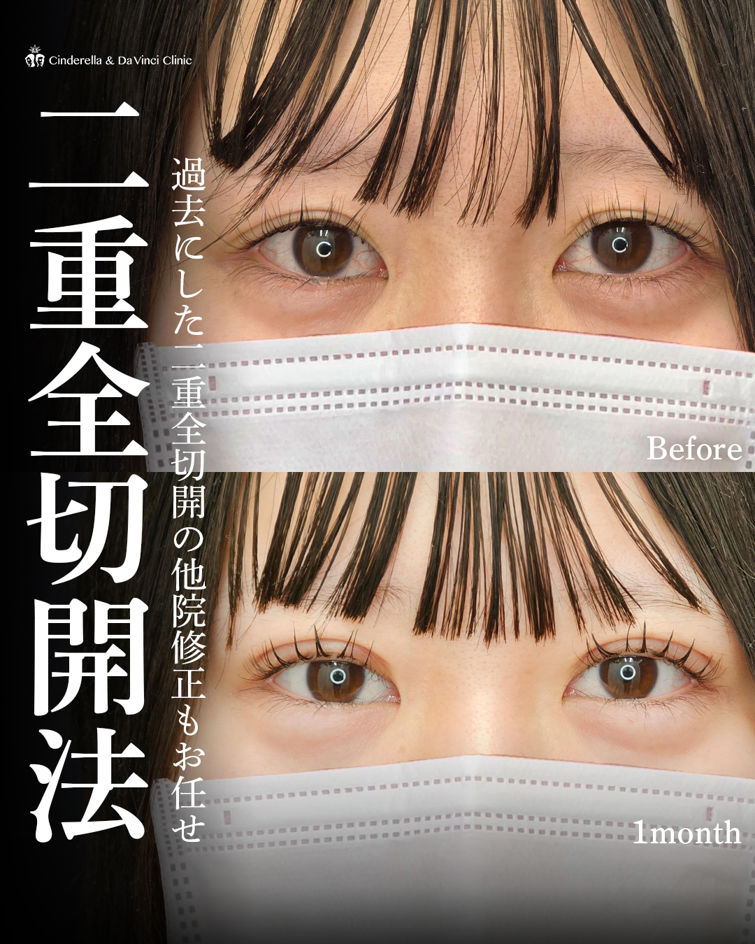 過去に他院でした目元修正もお任せの画像