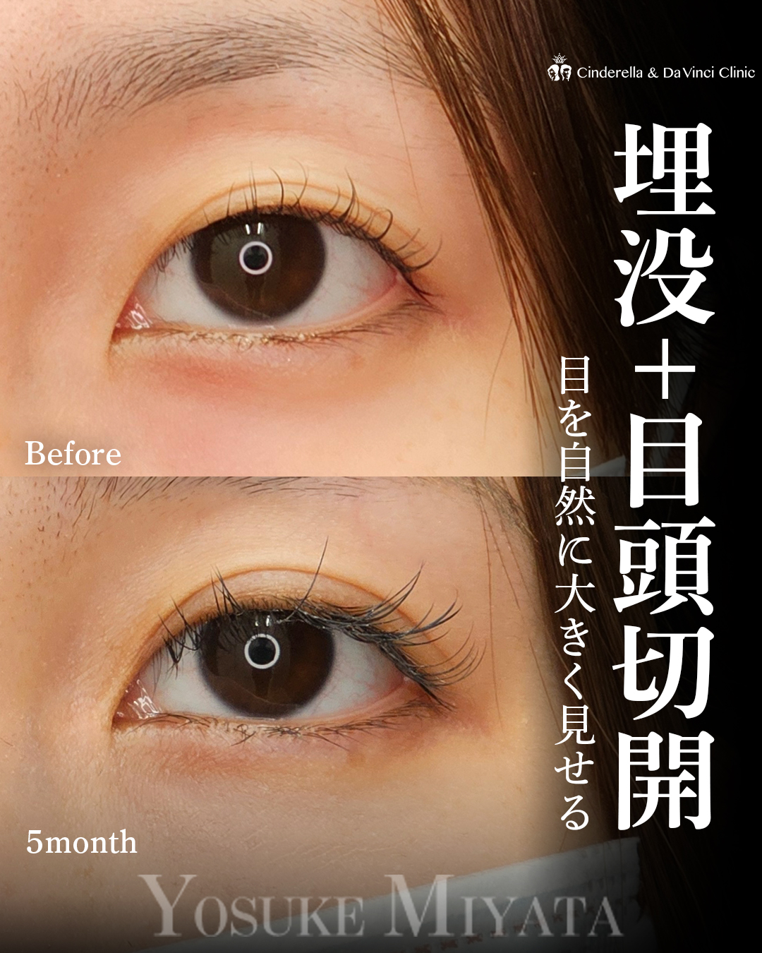 同時施術で目を大きく見せるの画像