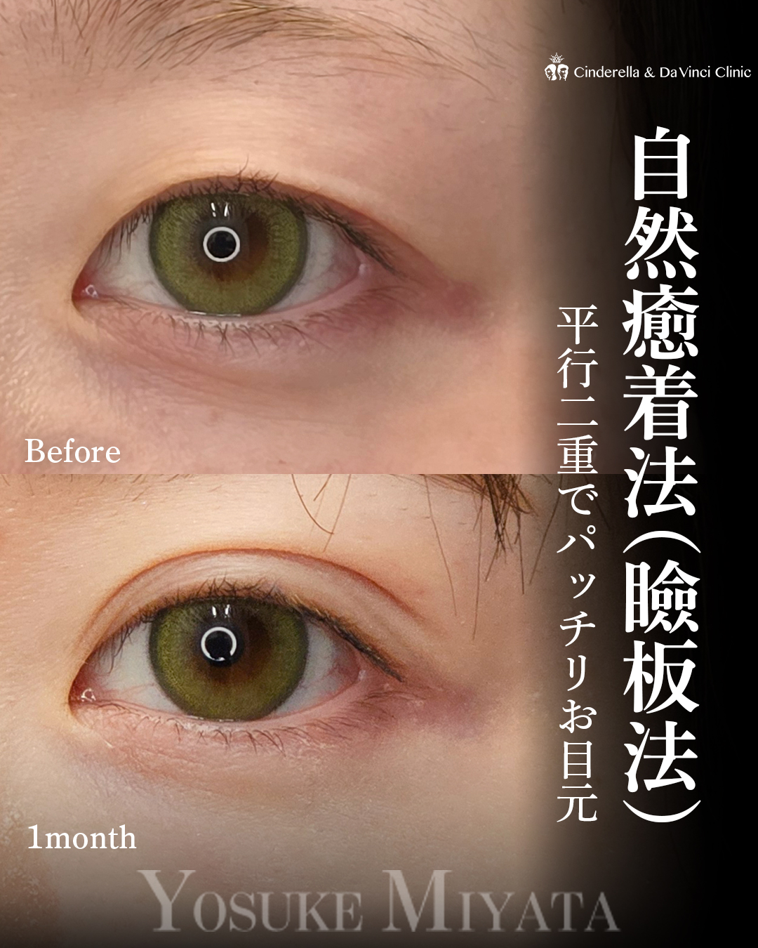 二重埋没でアイプチ卒業の画像