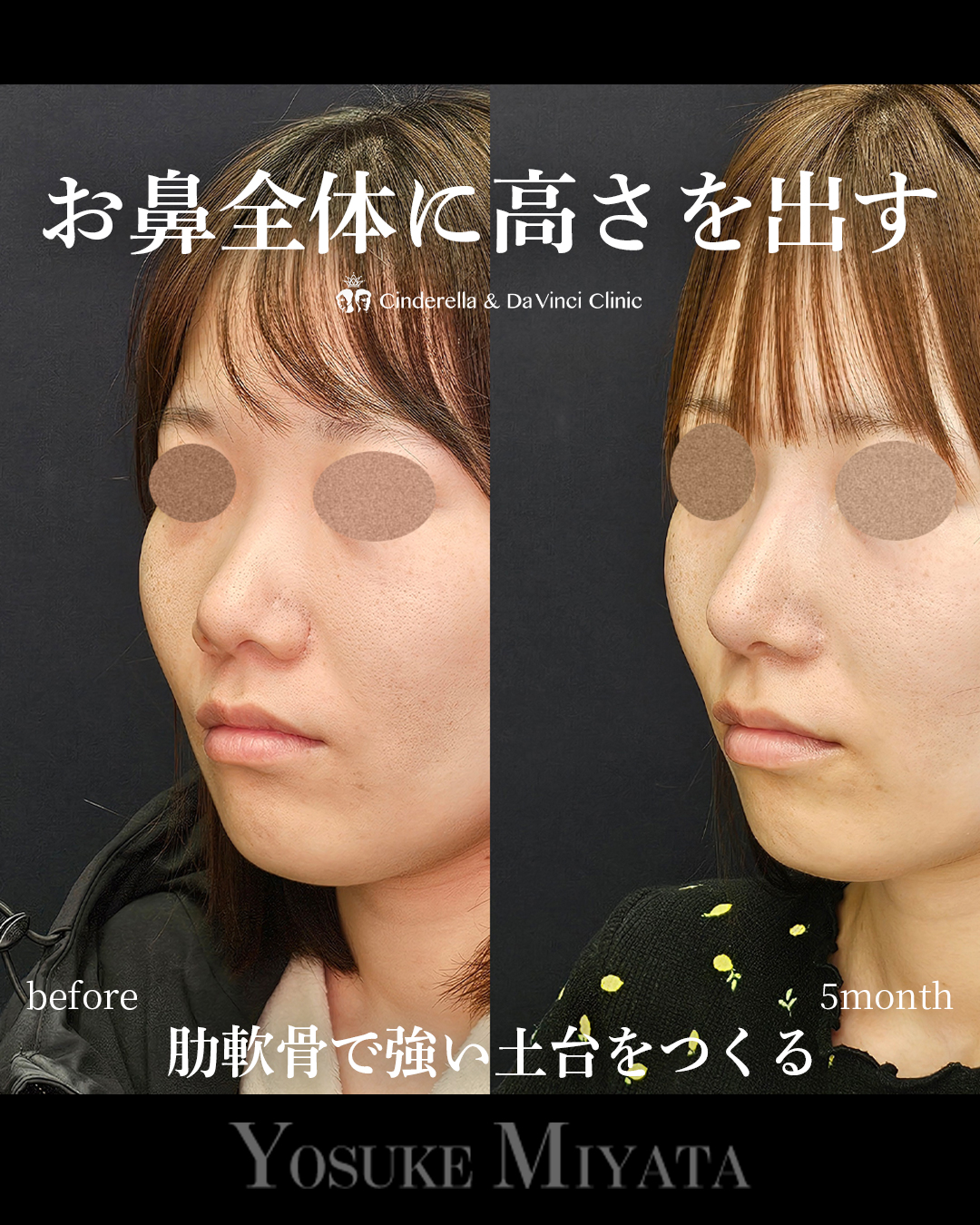 お鼻全体に高さを出すの画像