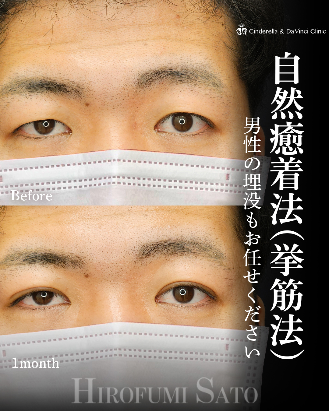 二重埋没でナチュラル印象チェンジの画像