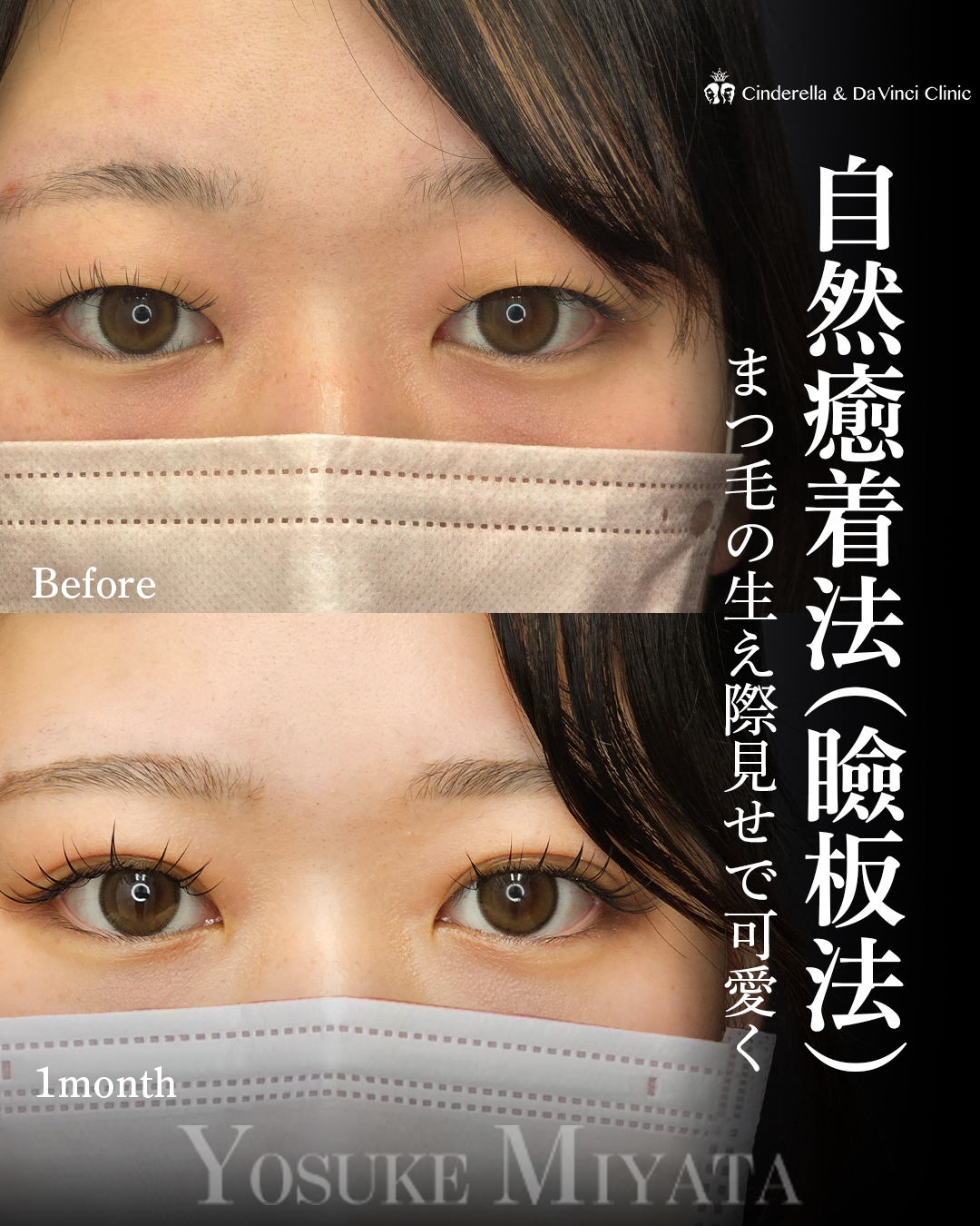 ナチュラル二重で整形感なしの画像