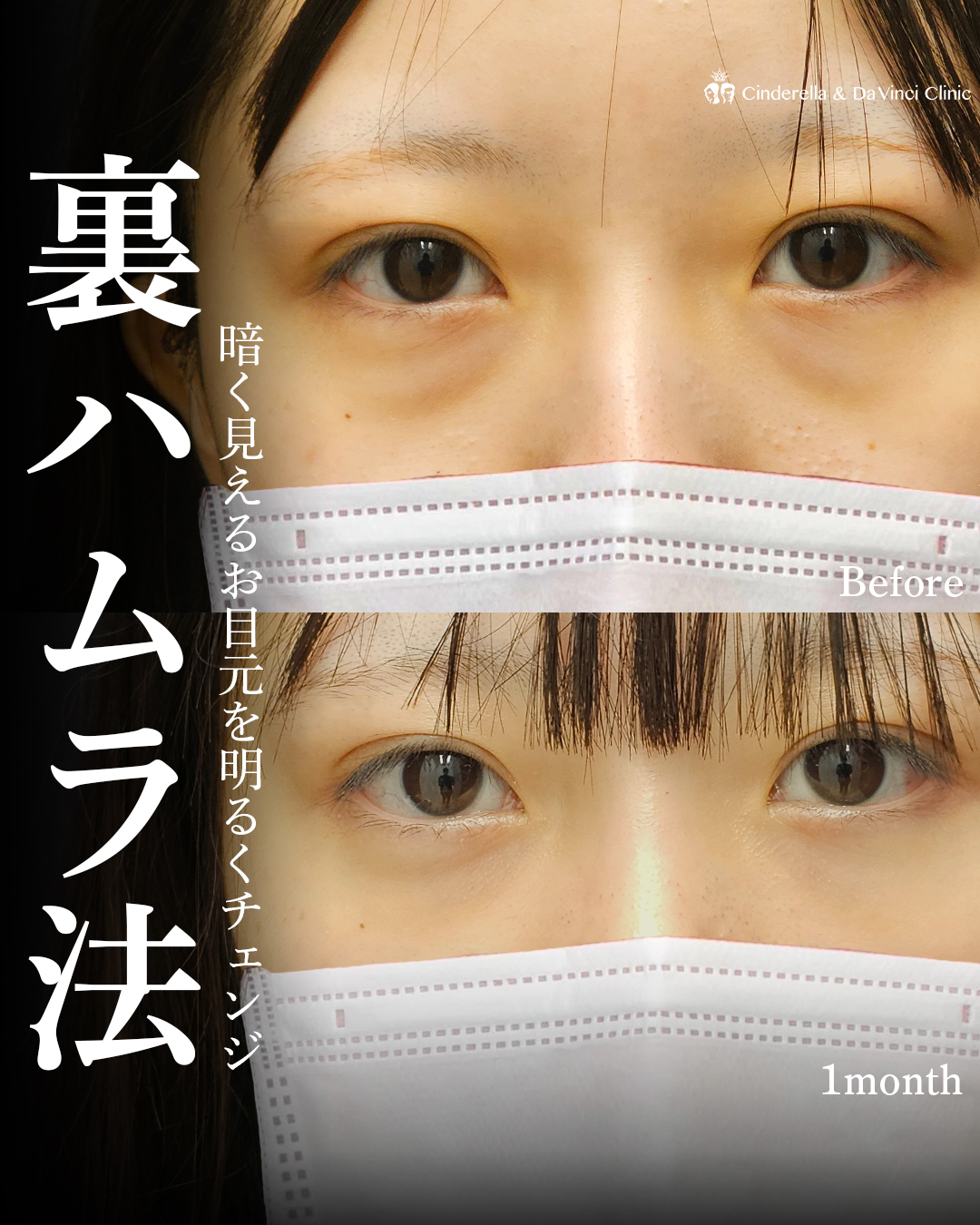 影クマ改善でお目元明るくの画像