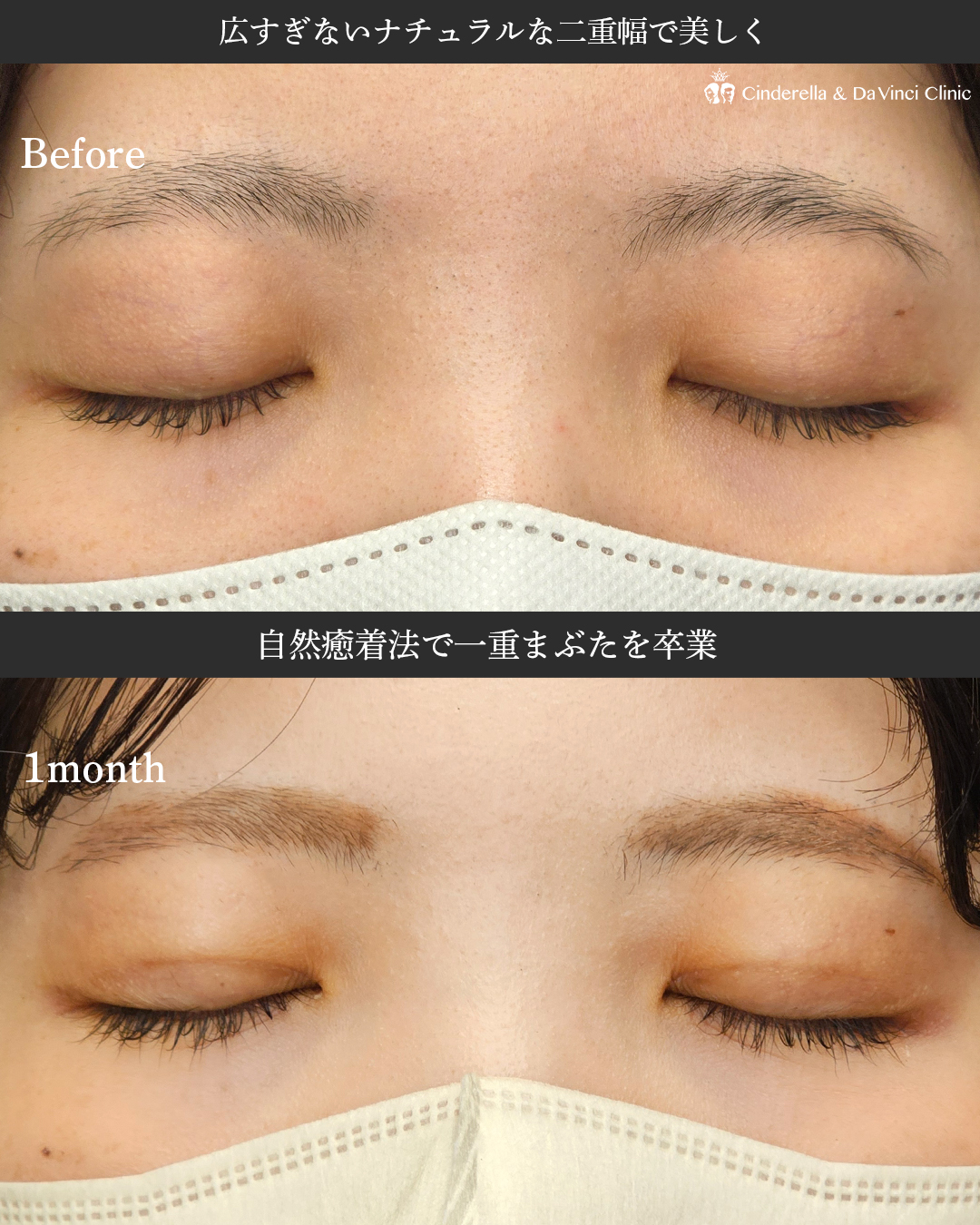 二重埋没でナチュラル盛れ目にの画像