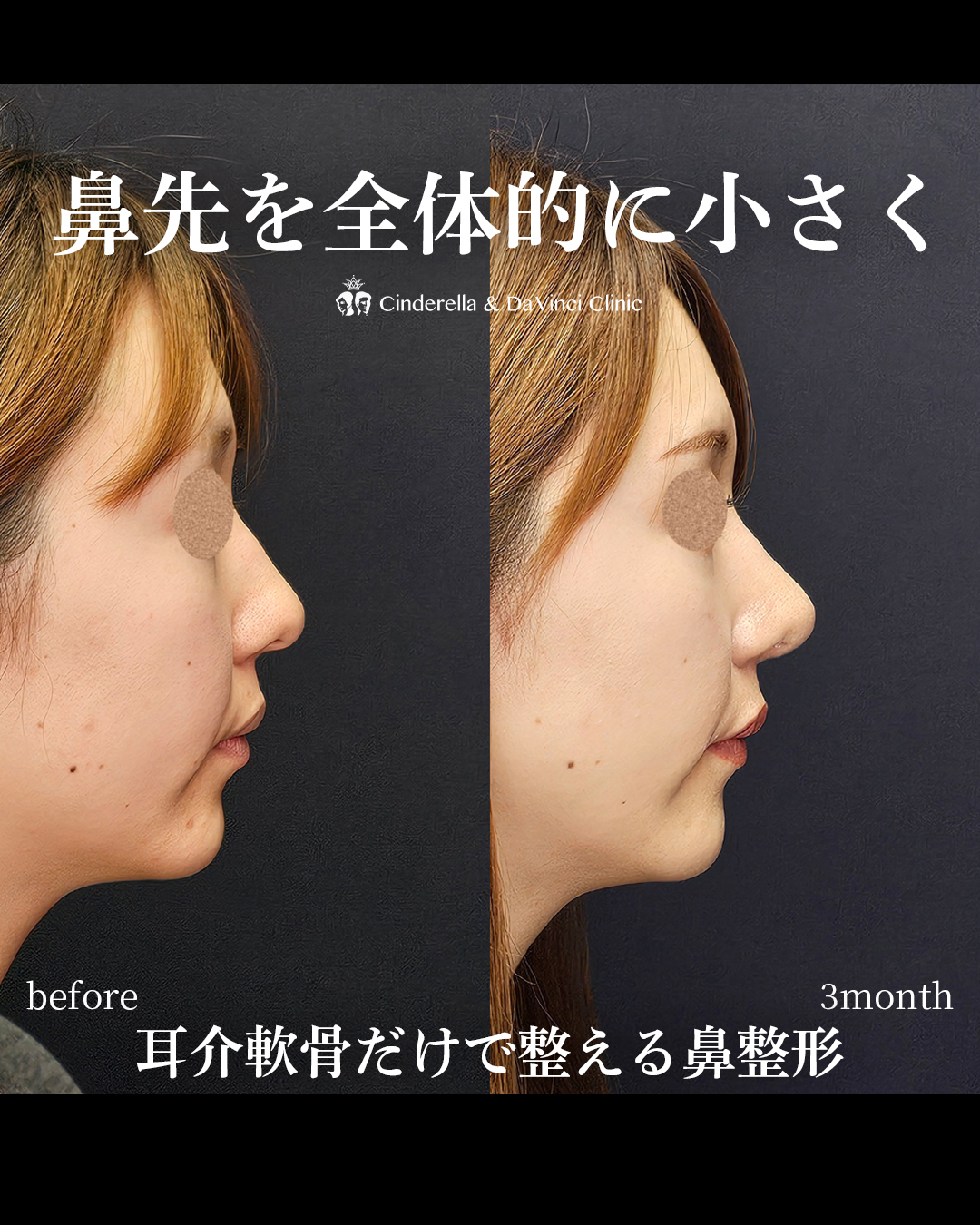 鼻先を全体的に小さくの画像