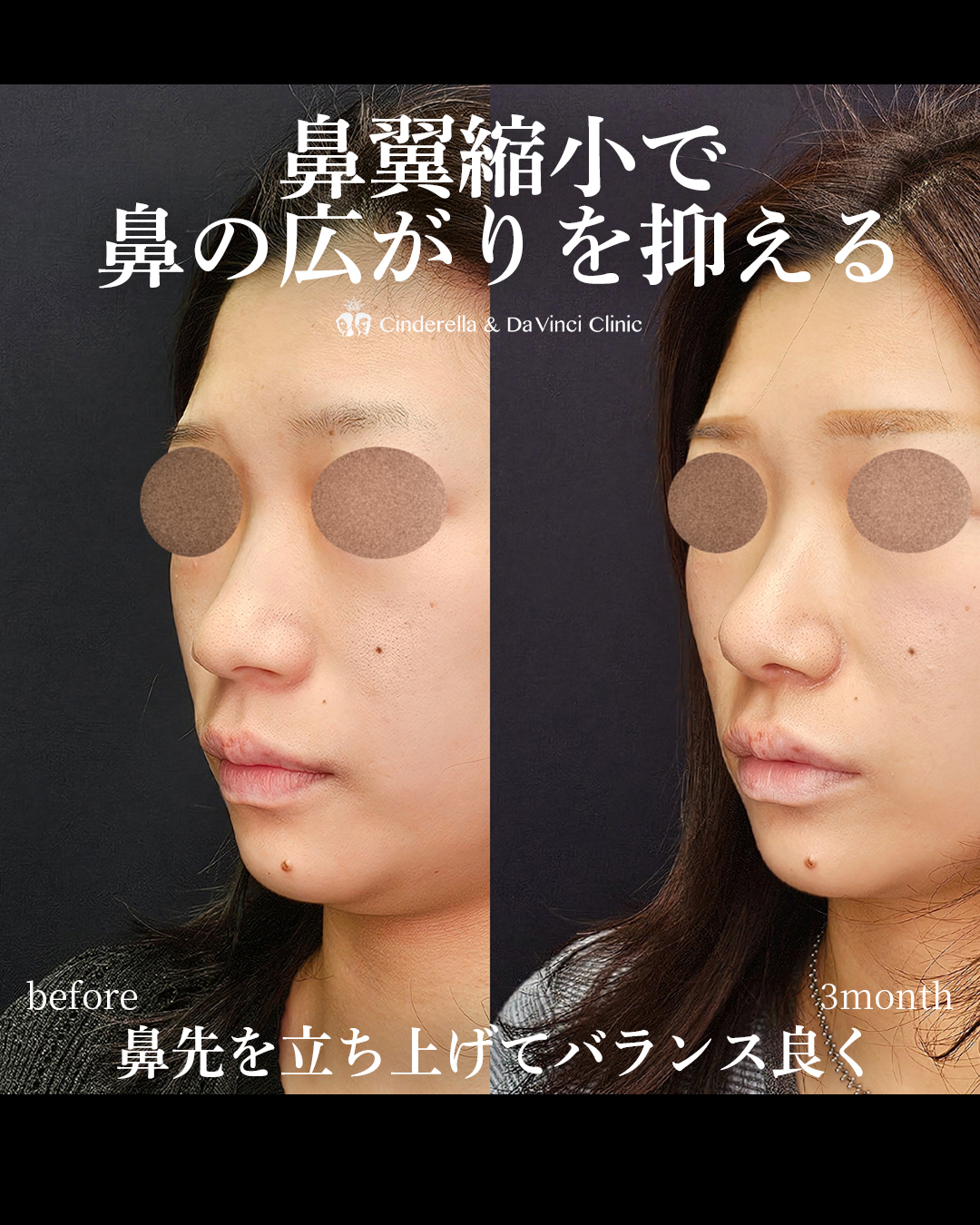 鼻の広がりを抑えるの画像