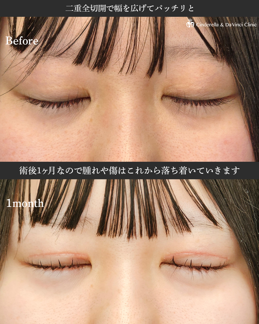 過去に他院でした目元修正もお任せの画像