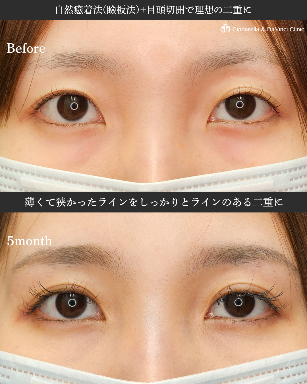 同時施術で目を大きく見せるの画像